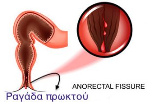 Ραγάδα πρωκτού | Πρωκτολόγος Θεσσαλονίκη