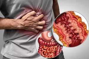 Νόσος του Crohn | Ιωάννης Παπαγιαννόπουλος Χειρουργός Θεσσαλονίκη